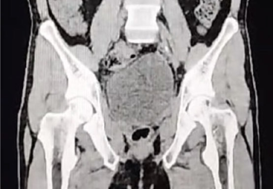 Sarcoma del Estroma Prostático en un paciente de 41 años de edad. Primer caso reportado en Ecuador