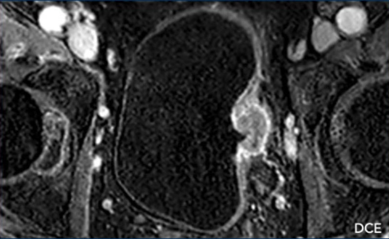 Rol de la resonancia multiparametrica de  vejiga en cáncer de vejiga